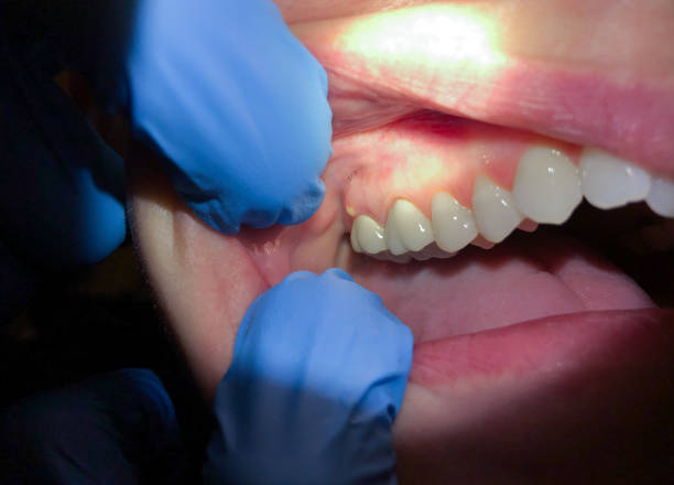 Best Emergency Treatment for Dental Infections or Abscesses in Newport, RI