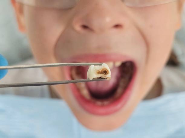 Best Emergency Treatment for Dental Infections or Abscesses in Newport, RI